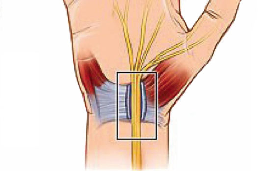 Carpal Tunnel Release Surgery