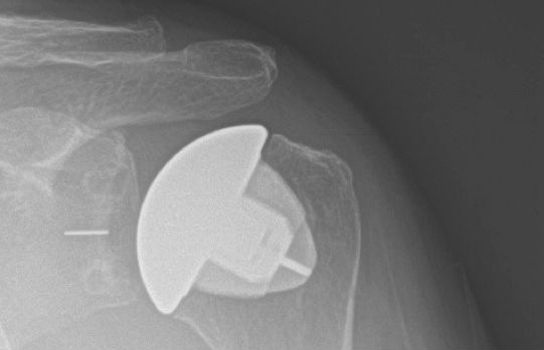 Shoulder Replacement Surgery