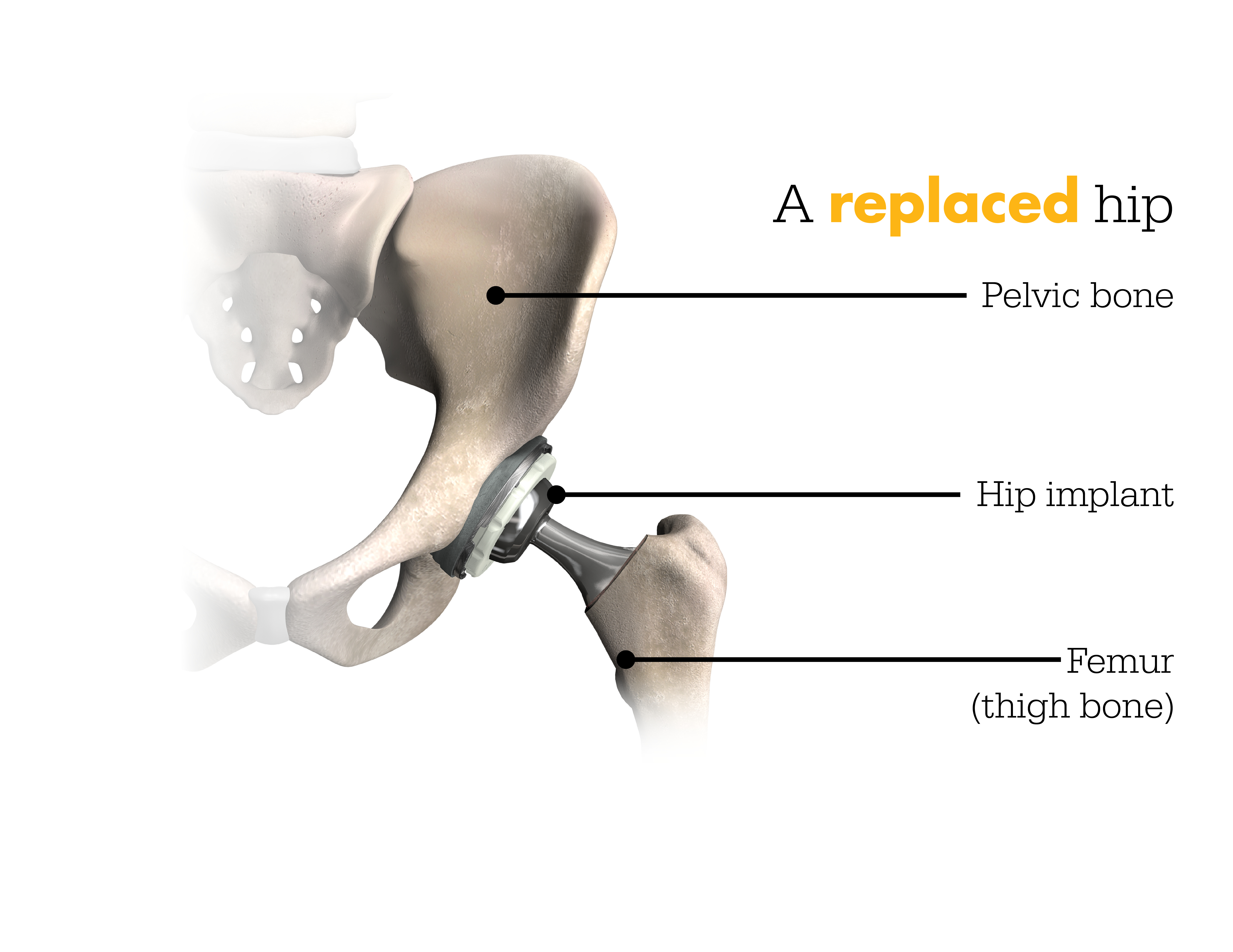 Replaced hip diagram