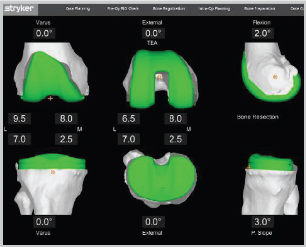 Mako viewing total knee