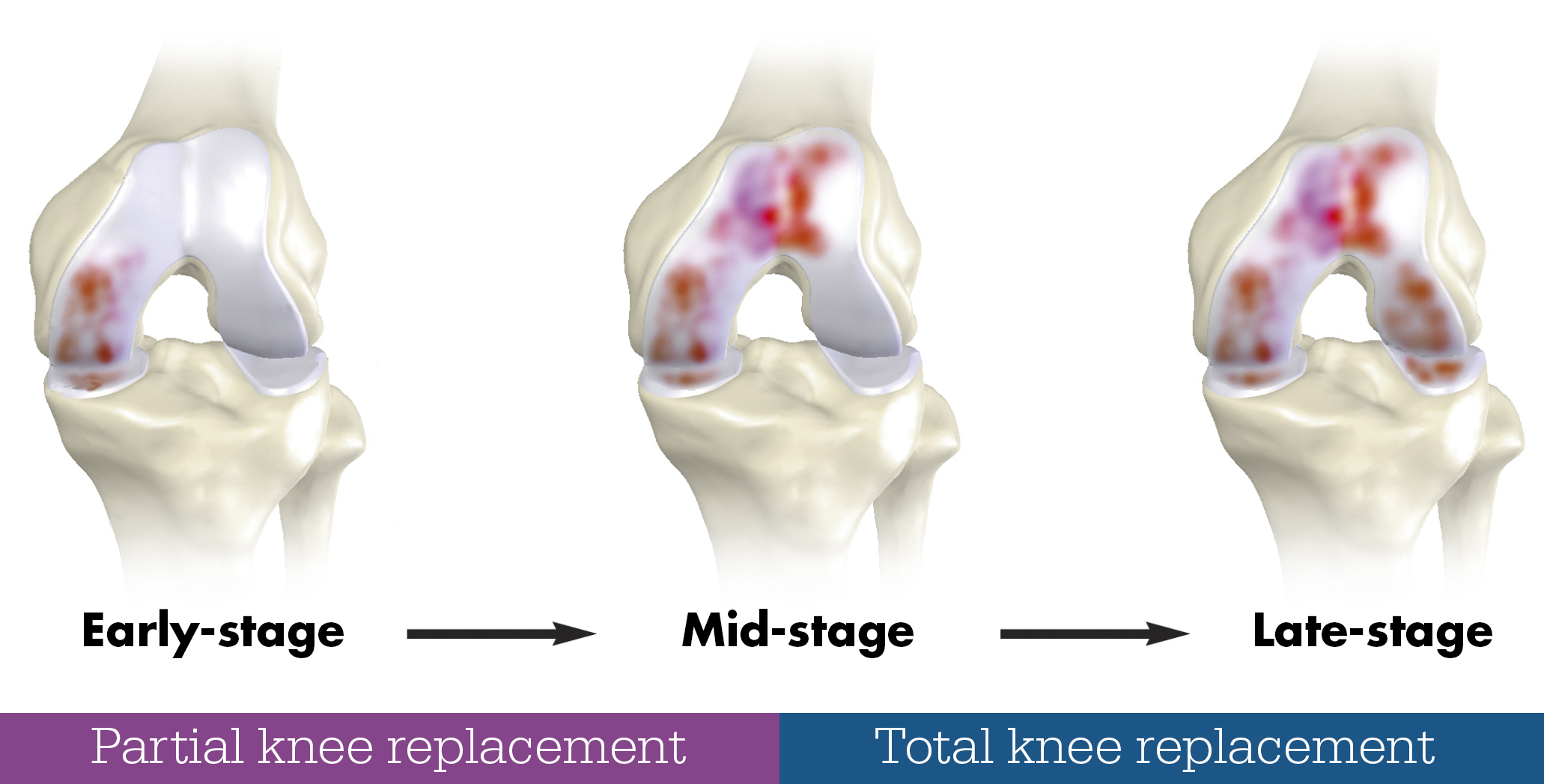 Partial vs Total knee replacement diagram